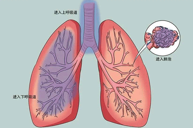 哪些人易得尘肺病,尘肺病可以根治吗?