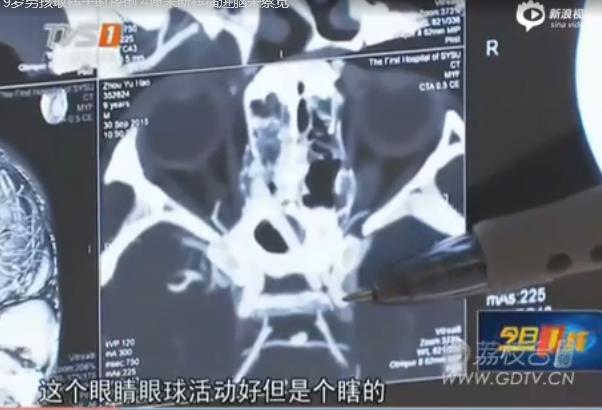 [<em>视频</em>]9岁男孩不慎摔倒 断筷插颅竟未察觉_山东